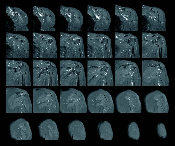 Rezonans Magnetyczny Obrazowania Lewego Barku Rotatora Rozdarcie Mankiet Podejrzeniem Tłuszczaka — Zdjęcie stockowe