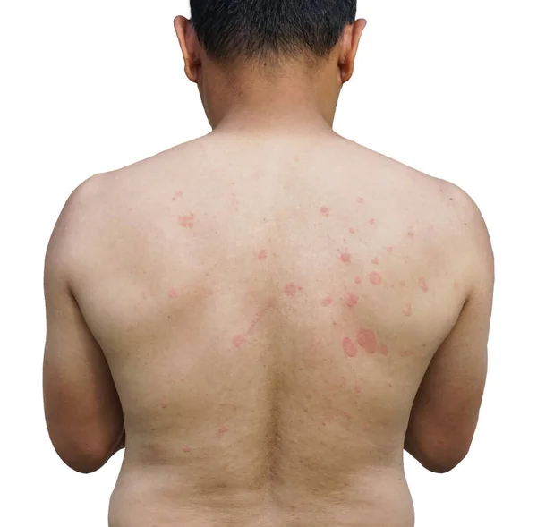 Infezione Verme Anello Sul Corpo Posteriore Dermatofitosi Sulla Pelle Dermatite — Foto Stock