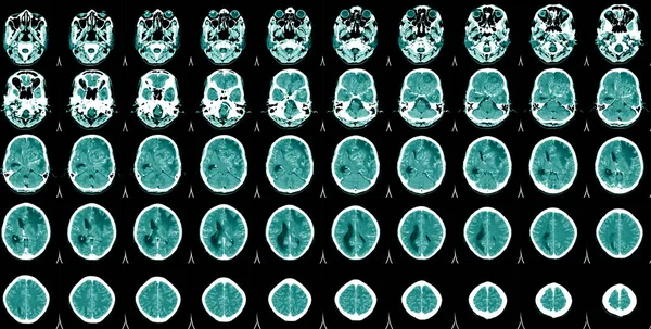 World Stroke Day Scan Brain Hombre Que Sufre Dolor Pulsátil —  Fotos de Stock