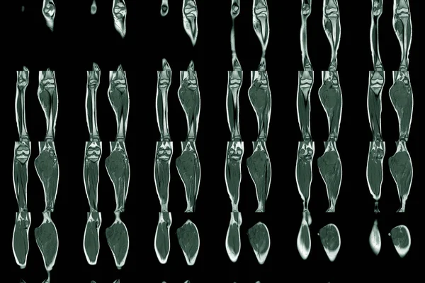 Magnetic Resonance Imaging (MRI) lower extremity both legs  showing tumor or mass at leg calf,Medical technology concept.