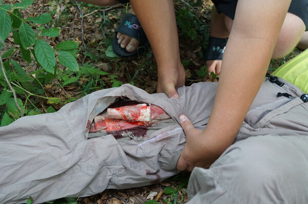 Стабилизация открытых переломов
