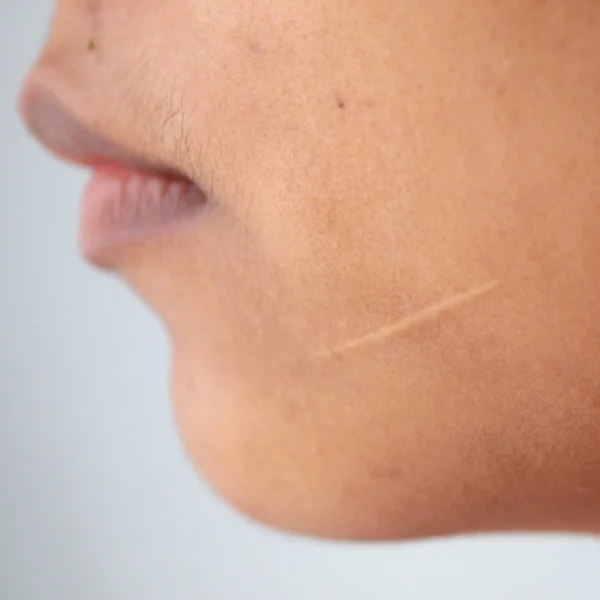 Scars on the face — Stock Photo, Image