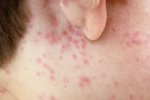 Detalhe dos efeitos da varíola de frango — Fotografia de Stock