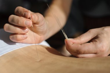Acupuncture.Chinese tıp treatmen