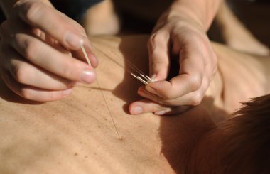 Acupuncture.Chinese tıp treatmen