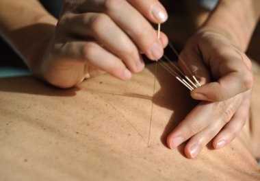 Acupuncture.Chinese tıp treatmen
