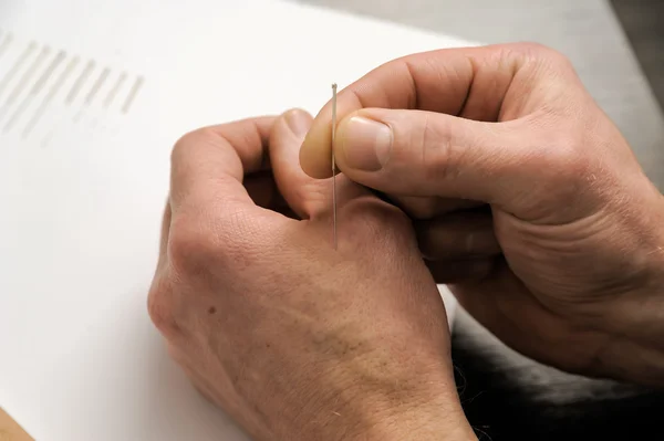 Acupuncture.Chinese medicína léčení — Stock fotografie