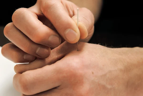 Acupuncture.Chinese медицины Treatmen — стоковое фото