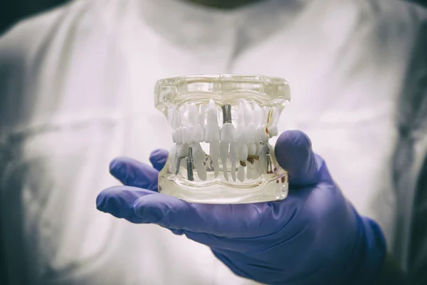 Smiling Dentist Hand Blue Gloves Hold Artificial Model Jaw Implants — kuvapankkivalokuva