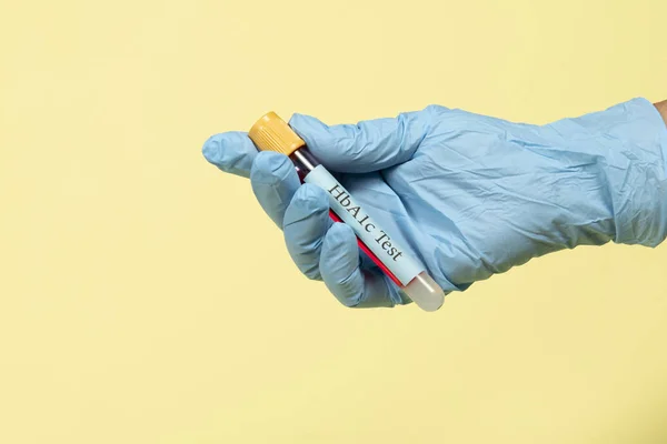 Hemoglobin için vakum tüpündeki kan örneği HbA1c test diyabeti teşhisi