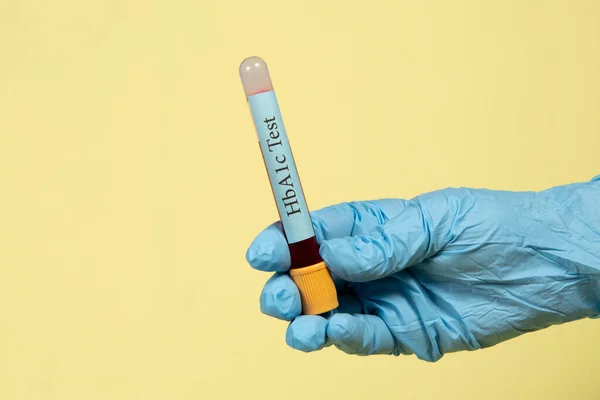 Hemoglobin için vakum tüpündeki kan örneği HbA1c test diyabeti teşhisi