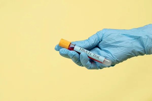Hemoglobin için vakum tüpündeki kan örneği HbA1c test diyabeti teşhisi