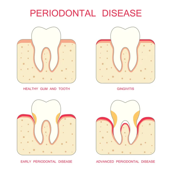 Diş periodontal hastalık