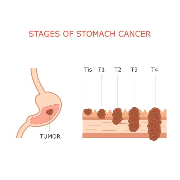 Stomach cancer stages — Stock vektor