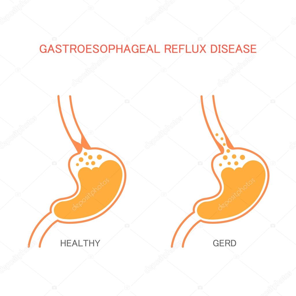 reflux  disease,