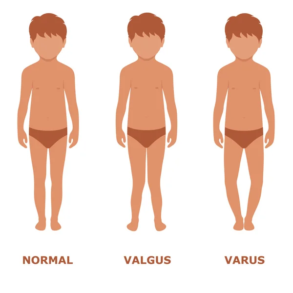 Valgus, varus knie, — Stockvector