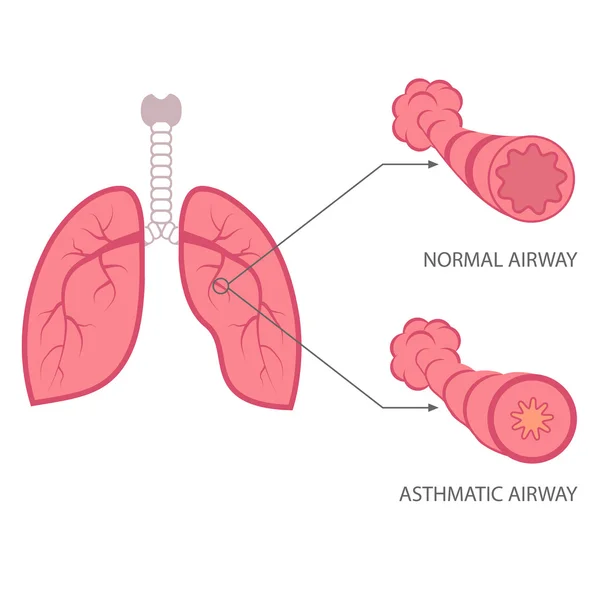 Άσθμα εικονογράφηση, βρογχικά, πνεύμονες αναπνευστικού — Διανυσματικό Αρχείο