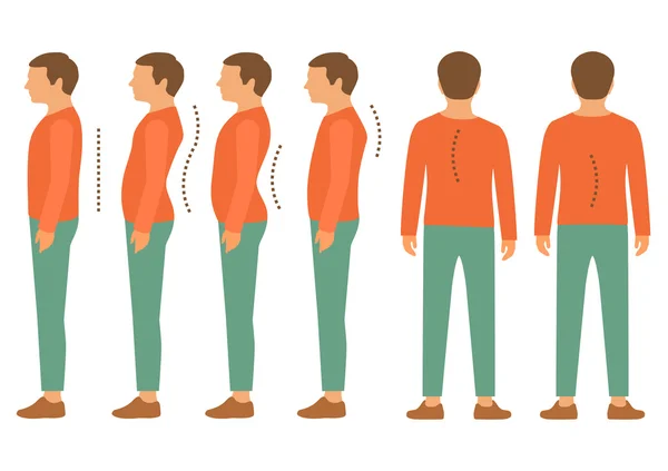 Escoliosis, lordosis espinal — Archivo Imágenes Vectoriales