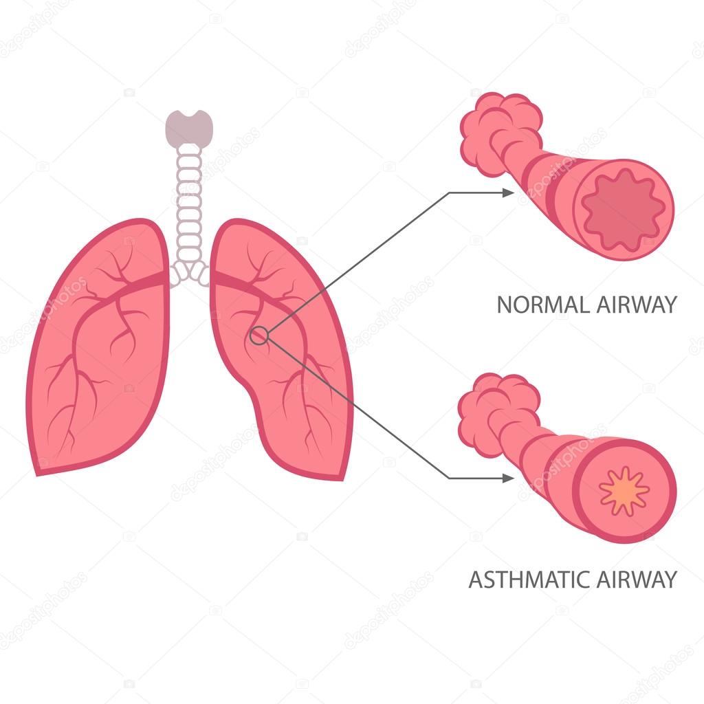 asthma illustration, bronchial, lungs respiratory