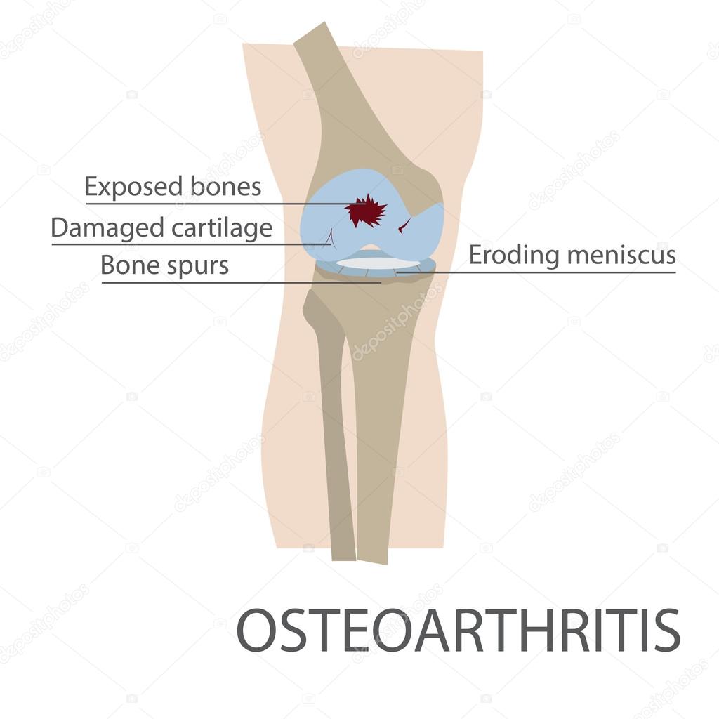 vector illustration of osteoarthritis disease