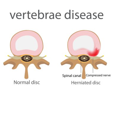 hernia. vertebrae disease clipart