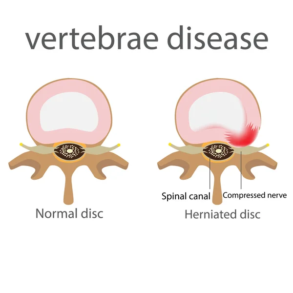 Hernia. enfermedad de las vértebras — Archivo Imágenes Vectoriales