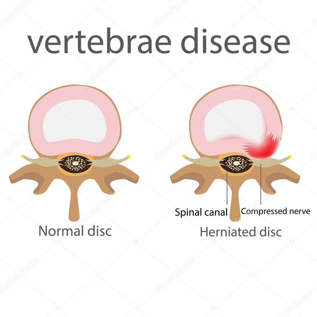 hernia. vertebrae disease