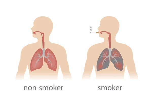 Wektor płuc porównanie — Wektor stockowy