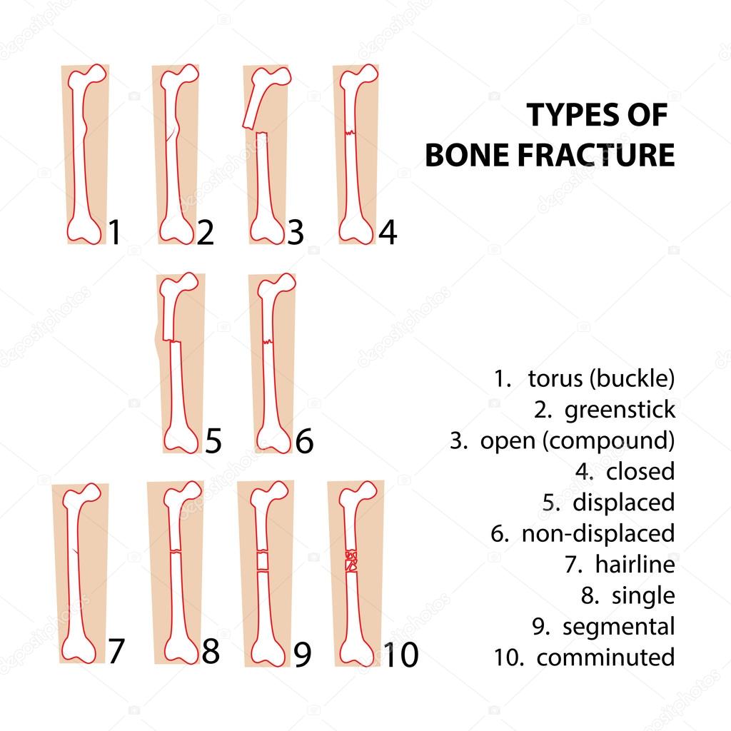 bones fractures