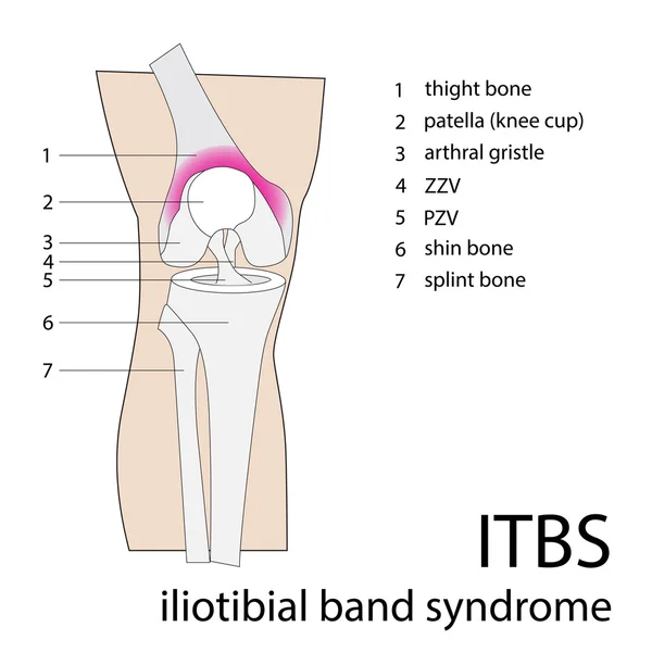 Sindrome di itb — Vettoriale Stock