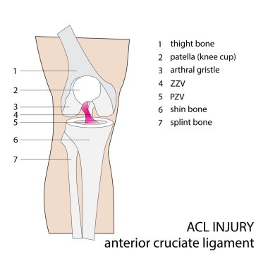 ACL injury clipart