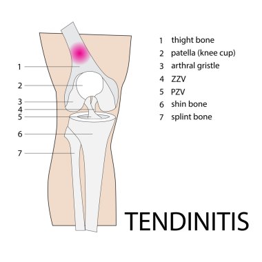 tendinitis injury clipart