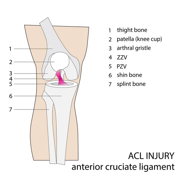 ACL yaralanma