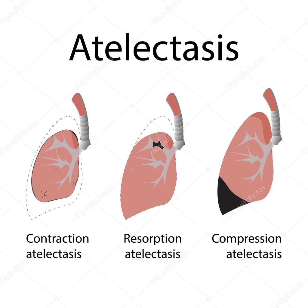 lung disease