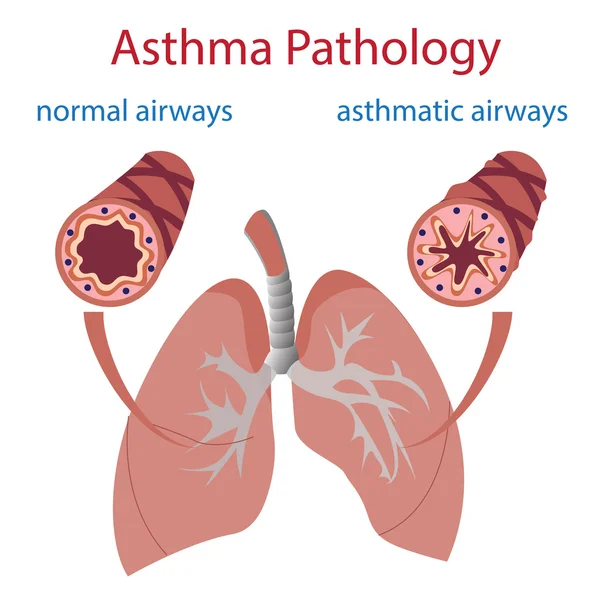 Patologia da asma —  Vetores de Stock