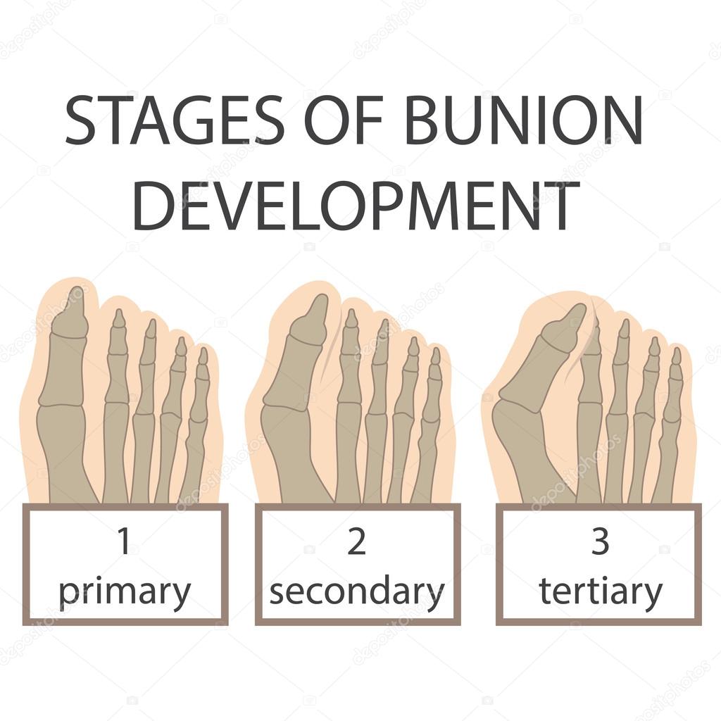 vector bunion development