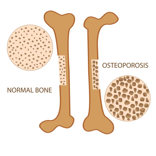 골다공증 뼈 해부학 — 스톡 벡터