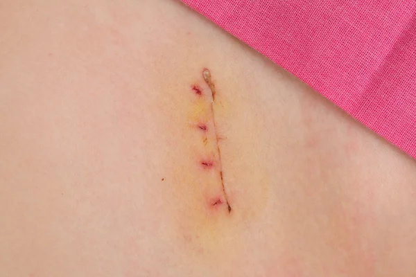 Closeup of fresh appendix surgery scar, appendectomy - Stock Image. 