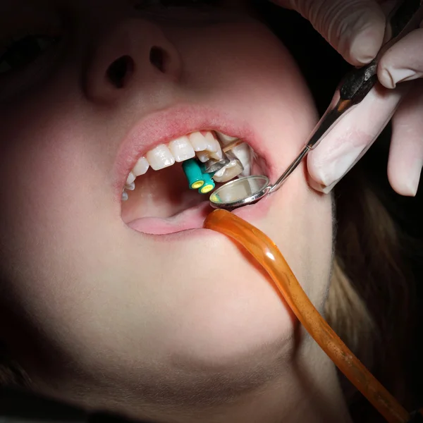 Procedura dentale, perforazione e riempimento dei denti — Foto Stock