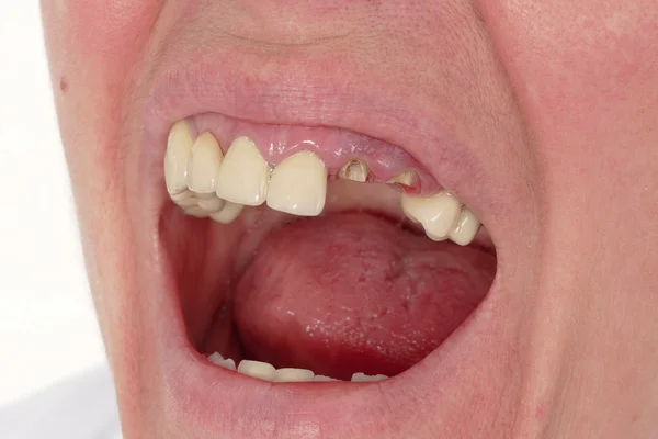 Dental, trasiga tänder — Stockfoto