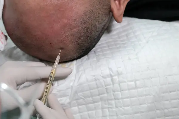 Close up of balding man getting hair mesotherapy or scalp prp: Platelet-rich plasma procedure. Beautician doctor makes injections in the man head for hair growth against alopecia.