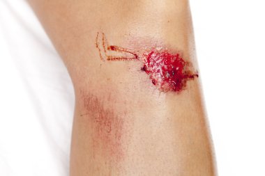 Close up on an scraped knee after fell down clipart