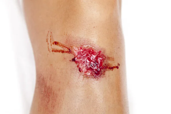 Close up on an scraped knee after fell down — Stock Photo, Image