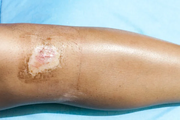 Guérison des blessures sportives sur le genou humain — Photo