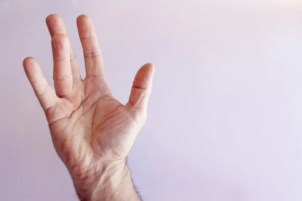 Hand eines Mannes mit Dupuytren-Kontraktion — Stockfoto