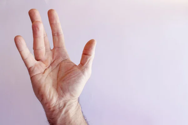 Hand eines Mannes mit Dupuytren-Kontraktion Stockbild