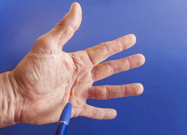 Hand van een man met de Contractuur van Dupuytren op blauw Stockfoto