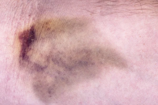 Primer plano de un hematoma —  Fotos de Stock