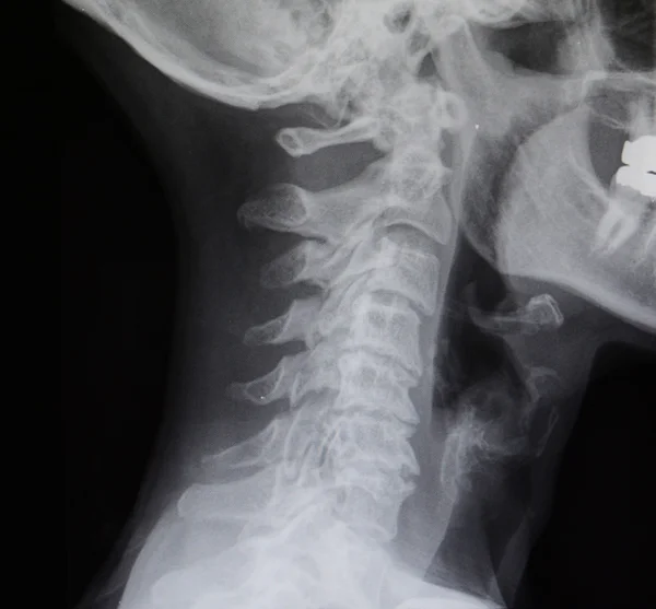 Human cervical spine X-Ray — Stock Image Human cervical spine X-Ray Stock Picture