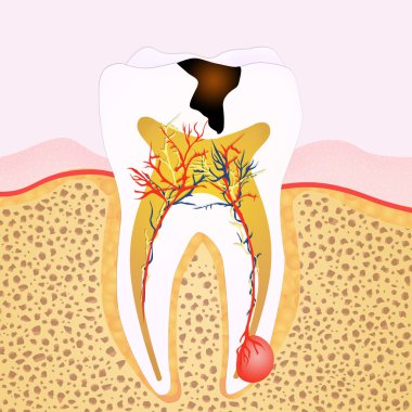 phase of caries clipart